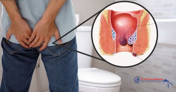 best piles surgery in mancherial