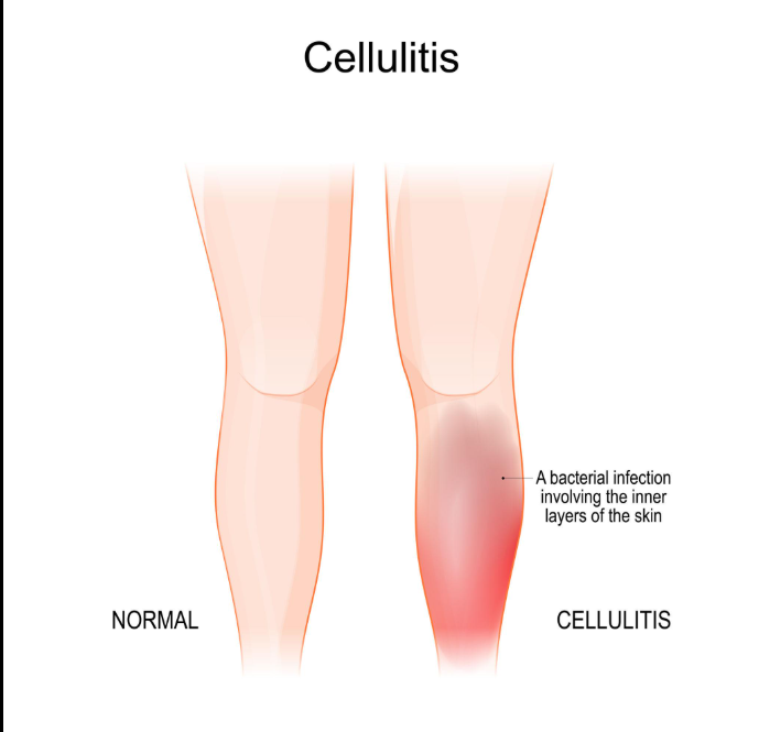Cellulitis symptoms